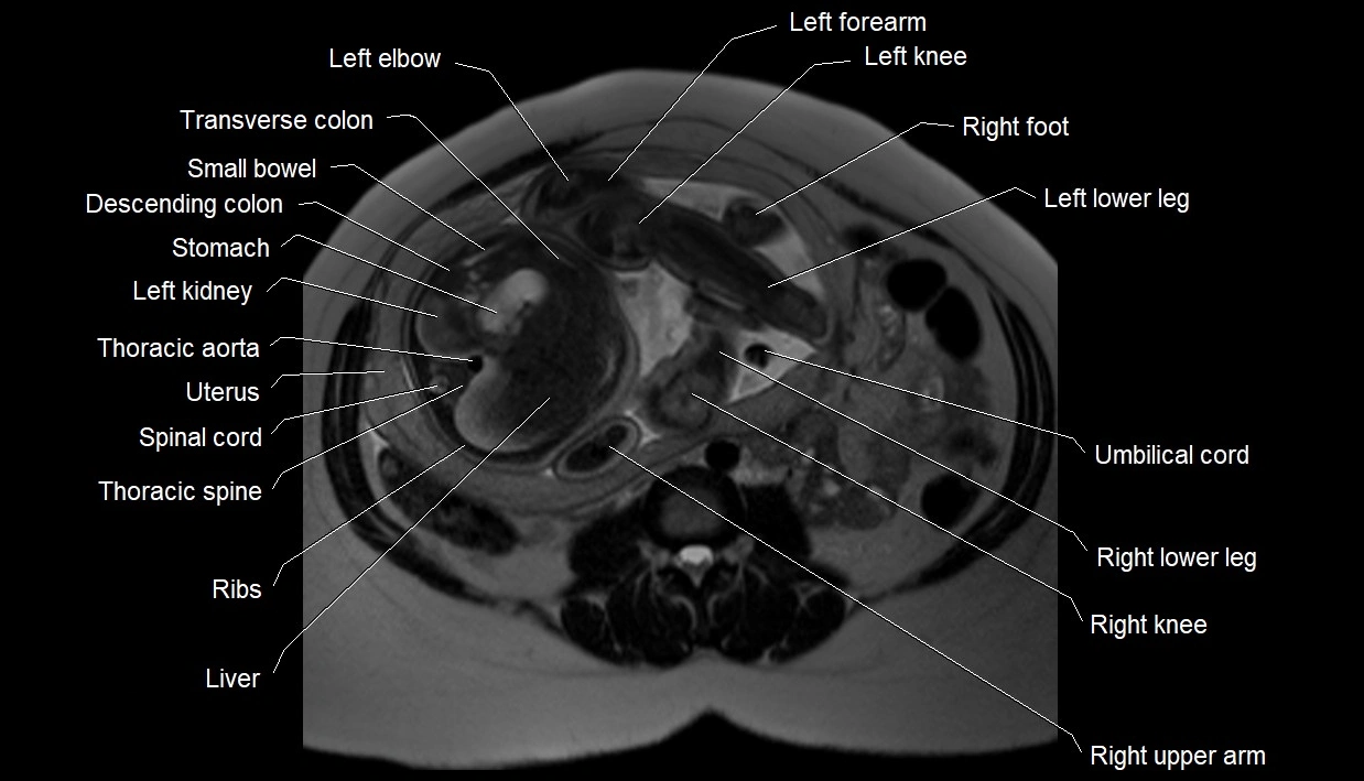 MRI fetal anatomy axial image 12.webp